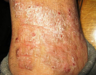 初期湿疹的症状表现