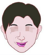 针灸治疗面瘫效果