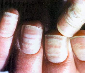 灰指甲的初期症状_如何彻底治愈灰指甲