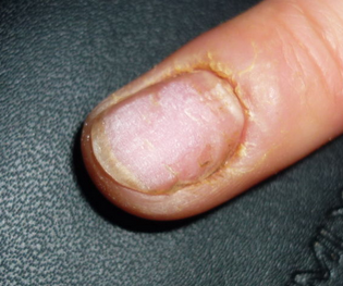 灰指甲症状类型有哪些