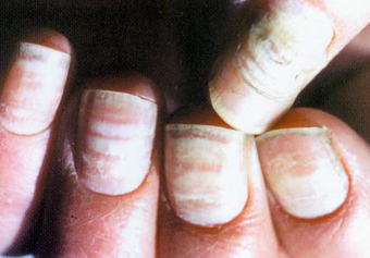 灰指甲早期的症状