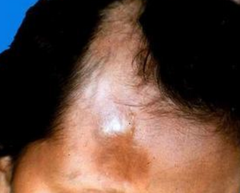 皮肤科 硬皮病 症状  对于硬皮病这样的病症大家可能不是特别的了解