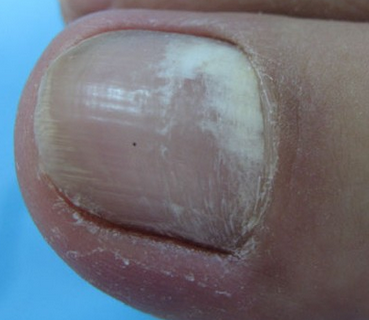 轻度灰指甲症状有哪些