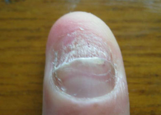 灰指甲的症状及病因