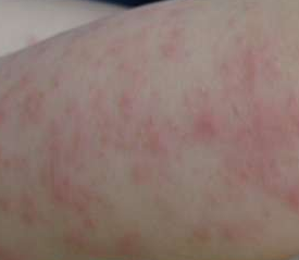 儿童湿疹的症状有哪些