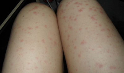 我们来说下寻麻疹的症状情况,一般来说,症状表现主要是皮肤出现了风团