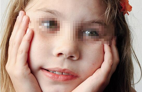 如何治面瘫的有效方法?