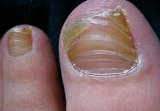 脚灰指甲的初期症状有哪些