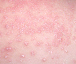 湿疹感染初期症状治疗方法有哪些-湿疹症状-复禾健康