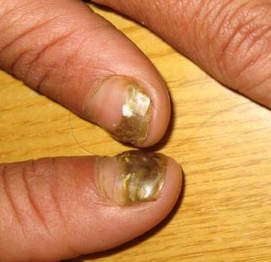 小孩灰指甲症状有哪些