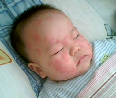 婴儿荨麻疹病症状有哪些