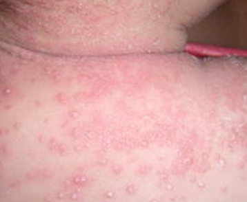 婴儿湿疹会引起哪些症状婴儿湿疹的危害都有哪些