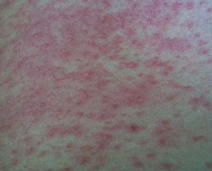 湿疹的早期症状有哪些