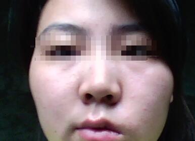 面瘫后遗症可以手术治疗吗?