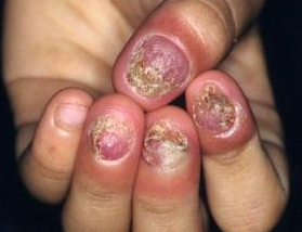 手指灰指甲初期症状