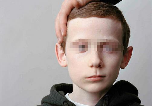 轻微面瘫的症状与治疗有哪些?