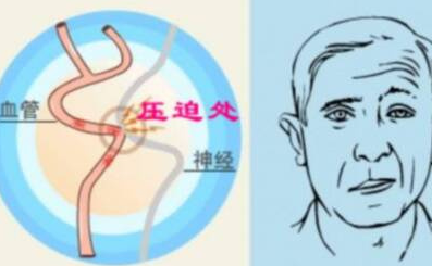 面瘫西医最佳治疗方法(面瘫),北京面瘫的最佳治疗方法