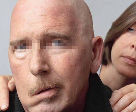 面瘫先兆症状有哪些?