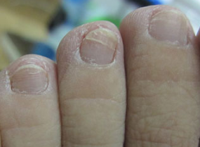 脚灰指甲早期症状