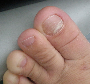 灰指甲症状初期的表现有哪些