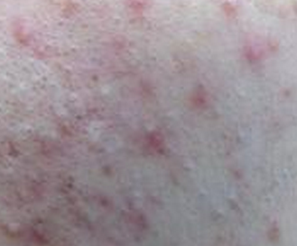 痤疮所有初期症状