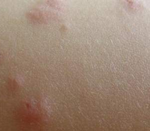 身体不同部位患上湿疹症状表现有哪些