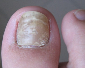 灰指甲的初期症状