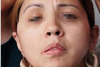 面瘫伴有发热症状吗?