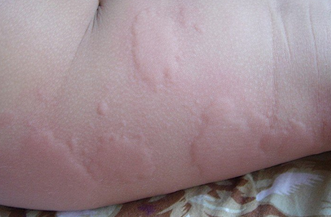 宝宝荨麻疹病的症状有哪些