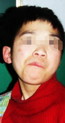 小儿面瘫症状与治疗