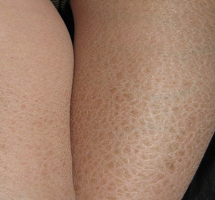 皮肤鱼鳞病治疗建议:鱼鳞病患者若能加强皮肤护理,如果接受正规合理