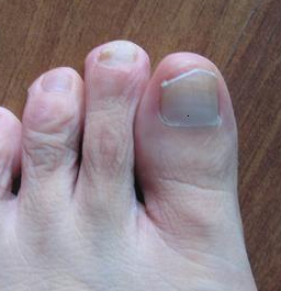 脚灰指甲的初期症状有哪些