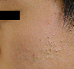 中度痤疮要多久治好