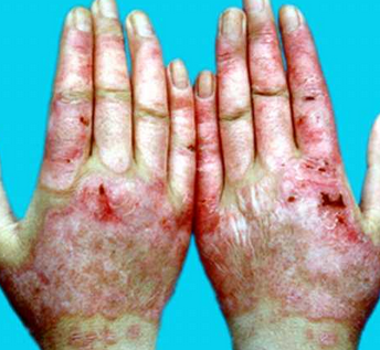 治疗  其实对于红斑狼疮这种疾病来说就是皮肤病的一种,做好红斑狼疮