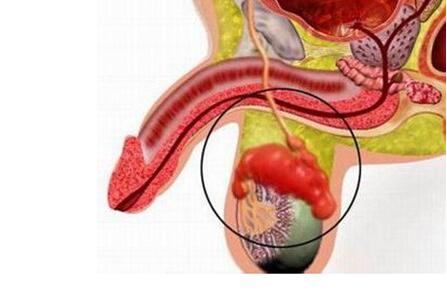 因为急性附睾炎的炎性包块有时体积超过睾丸的体积,如果严重可能会