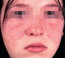面部红斑狼疮的症状表现有哪些