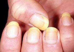 手灰指甲的治疗偏方