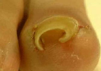 治疗脚趾甲沟炎方法有哪些