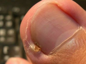 脚趾甲沟炎的鉴别诊断方法有哪些