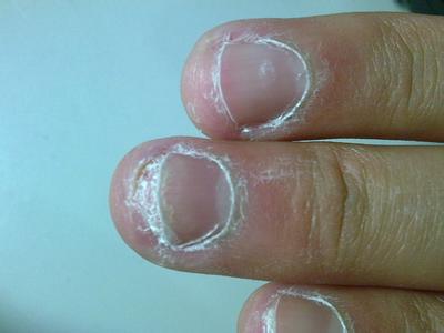 灰指甲的原因及危害