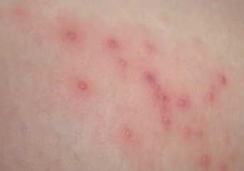 中药治疗湿疹怎么治疗