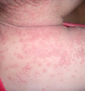干燥性湿疹如何治疗