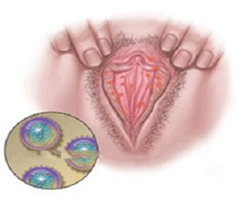 女性生殖器疱疹症状