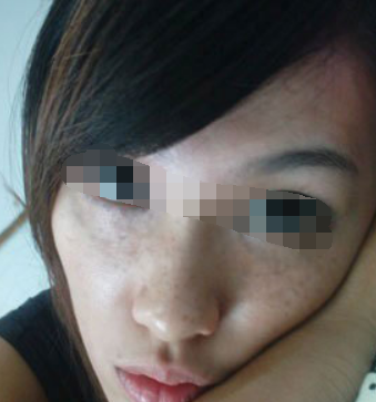 怎样能去掉脸上的色斑