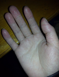 手湿疹症状有哪些