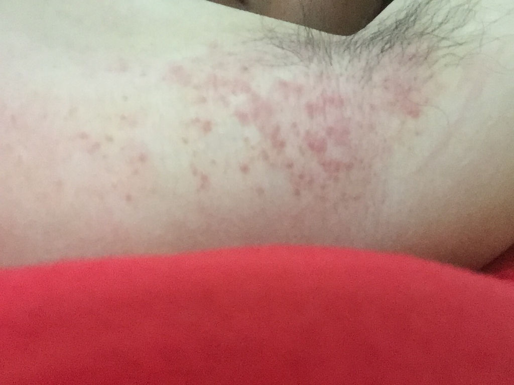 腋下湿疹症状有哪些?