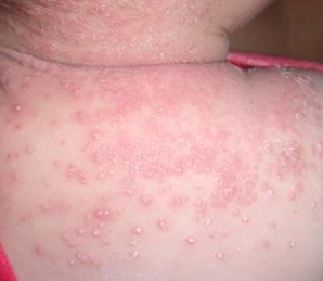 皮肤科 湿疹 治疗 通过上述对于宝宝湿疹的预防措施的介绍,我们