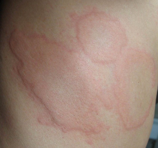 湿疹是过敏引起的吗