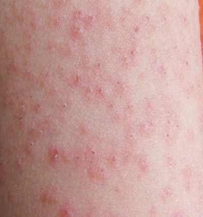 治疗遇热性荨麻疹的偏方