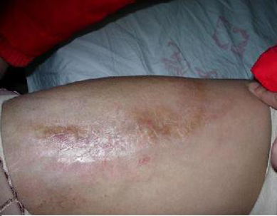 硬皮病怎么治疗有效